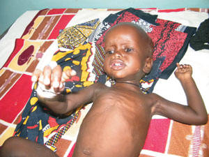 One-year-old John Epua is admitted to Lodwar District Hospital, in Kenya's Turkana Central district, after he was diagnosed with malnutrition.  Photo:Ochieng/Kenya Standard&nbsp;