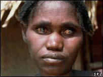 River blindness is caused by infection with a parasitic worm. Photo: SPL