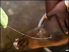 he infection culminates in worms emerging from the sufferer's skin. Photo: BBC News
