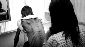 A 49-year-old man in the advanced stages of HIV has not told friends about his situation because of the social stigma attached to the disease. "The worst thing for me is the loneliness," he said. Two weeks after this photograph was taken, he died. For many people infected with HIV  in developing countries,  lack of nutritious food frequently speeds death, or, when anti-retroviral treatment for HIV is available, reduces the effectiveness of the treatment. Photo: International Herald Tribune