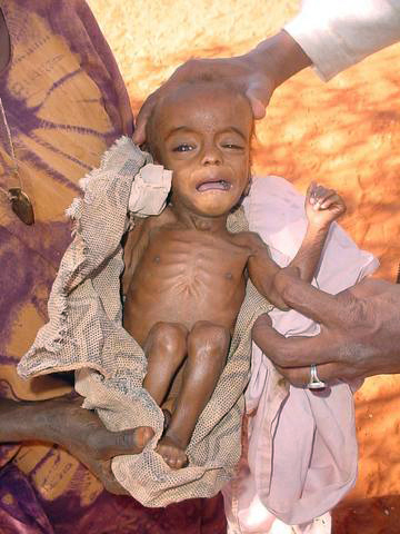 20054142_malnourished_child_somalia